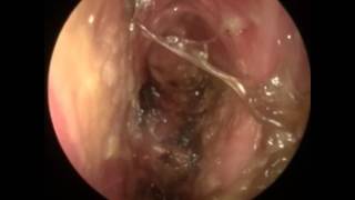 Chronic rhinosinusitis Empty nose syndrome [upl. by Ravert]