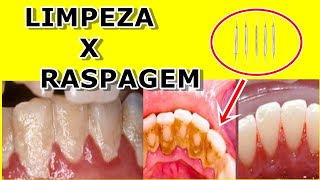 Qual a Diferença entre Limpeza e Raspagem nos Dentes [upl. by Eelyk]