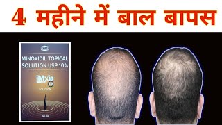 Minoxidil for hair Imxia 10 solution minoxidil side effects [upl. by Artep]