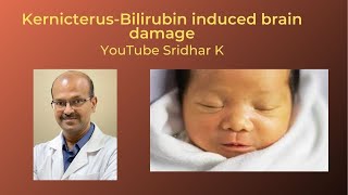 Kernicterus and BIND bilirubin induced neurologic damage Dr Sridhar K [upl. by Ocko694]