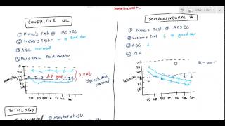 Conductive and Sensorineural Hearing Loss Deafness for USMLE [upl. by Hudgens729]