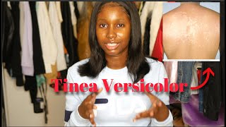 ITS NOT ECZEMA Treating my Tinea Versicolor  Black Skin Friendly [upl. by Macdougall]