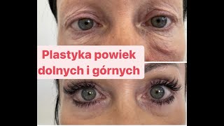 Plastyka powiek dolnych i górnych Jeden zabieg Blefaroplastyka przed i po Laserowa plastyka [upl. by Varick84]