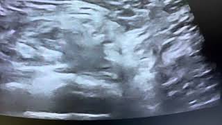 Ultrasound of direct inguinal hernia [upl. by Shepherd]