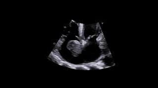 Primary Cardiac Synovial Sarcoma [upl. by Lipman]