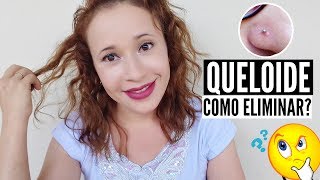 COMO ELIMINAR QUELOIDE DO PIERCING  DUAS DICAS  POR LEYA ARAGÃO [upl. by Nerahs]