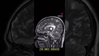 Case21 CEMRI brain infective granuloma neurocysticercosis colloid vesicular stage viral [upl. by Leiahtan]