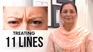 Treating 11 LinesFrown Lines [upl. by Gamaliel]