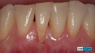 Abundo  Root coverage on a lower incisor 2stage treatment Preview [upl. by Nosnaj]