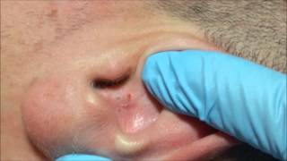 Ángels Acne Treatment Blackheads on the Ear [upl. by Nesline]