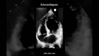 Takotsubo🐙 cardiology echocardiogram heartscan Takotsubo [upl. by Anohr733]