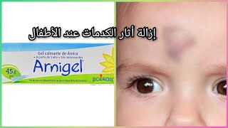 الحل الوحيد لإزالة الكدمات وعلاجها بسرعة عند الأطفال arnigel [upl. by Tima336]