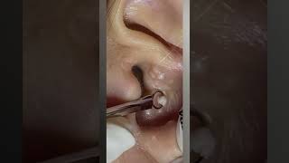 BEST BLACKHEAD amp CYST POPPING [upl. by Earleen]