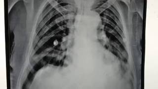 Colonic interposition between right dome of diaphragm Chilaiditi syndrome [upl. by Pitarys]