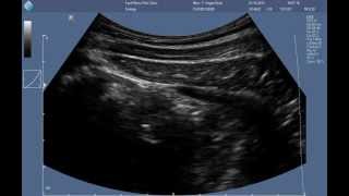 Abdominal RUSI ultrasound  correct contraction of the transversus abdominis [upl. by Othella]