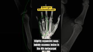 Tumor of the Hand shorts medical bones [upl. by Allana]