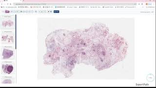 inflammatory myofibroblastic tumorIMT desmoid fibromatosis GIPATH [upl. by Rehctaht913]