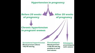 Preeclampsia eclampsia Anaesthesia Management [upl. by Petersen]