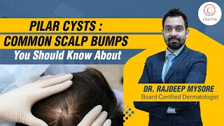 What is a Pilar Cyst Causes Treatment amp Removal Explained  Dr Rajdeep Mysore  Charma Clinic [upl. by Jamison31]