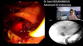 ERCP for acute cholangitis  hydatic cyst [upl. by Dasteel]