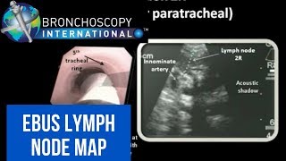 EBUS Lymph Node Map  Nodal Anatomy [upl. by Anicart]