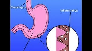 What is Gastritis [upl. by Ajaj]