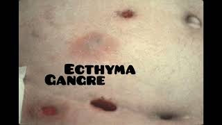 ecthyma causes symptoms and treatment dermatologyskin disease [upl. by Ttam776]