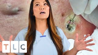 quotThe Award For The Biggest Blackheadquot amp A Juicy Cyst  Dr Pimple Popper This is Zit [upl. by Cibis]