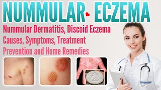 Nummular eczema causes symptoms treatment prevention and home remedies  Discoid Dermatitis [upl. by Jaehne]