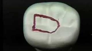 Endodontic Cavity Preparation  Phase I  Posterior [upl. by Jdavie815]