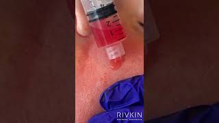 Microneedling with PRP by Natalie [upl. by Eyatnod]