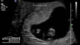 Scan of the Week 9 week old baby [upl. by Drais]