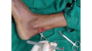 Sural Nerve Biopsy  Aura Skin Care Dr Ankit H Bharti [upl. by Hilar]