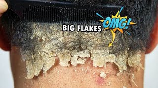 Psoriasis Scalp Scratching Big Flakes 610 [upl. by Refanej]