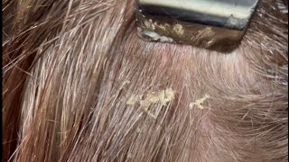 Scalp Psoriasis Treatment scalptreatment scalppsoriasis [upl. by Horodko]