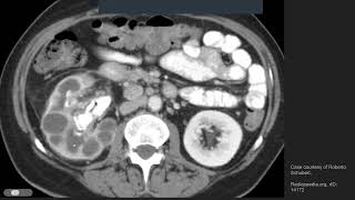 XGP xanthogranulomatous pyelonephritis [upl. by Eulalie]