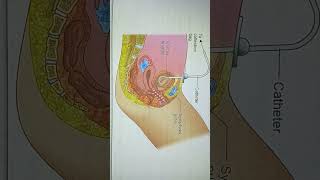 suprapubic catheter shortsvideo exam nursingzone norcet education biology [upl. by Balas]