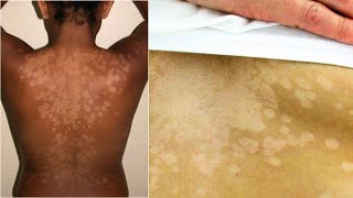 What is Tinea Versicolor Causes Treatment [upl. by Boyt]