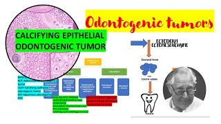 Calcifying epithelial odontogenic tumor CEOTDETAILEDPindborg tumor Tumors of odontogenic origin [upl. by Munn]