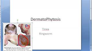 Microbiology 573 a DermatoPhytosis RingWorm Trichophyton Microsporum Epidermophyton ID reaction [upl. by Hymen]