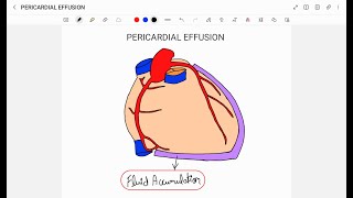 PERICARDIAL EFFUSION [upl. by Erodasi297]