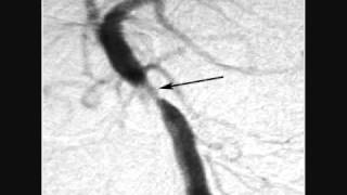 Basilar artery stenting [upl. by Holton]