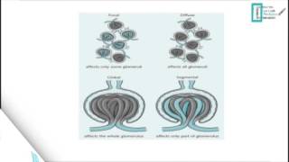 Glomerulonephritis [upl. by Nwahsid897]