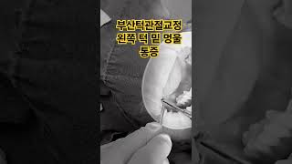 부산턱관절교정 왼쪽 턱 밑 멍울 통증 [upl. by Eirac]