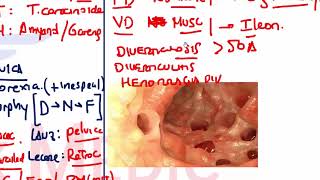 3 DIVERTICULITIS AGUDA [upl. by Yelwah]