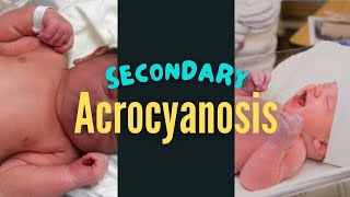 Secondary Acrocyanosis in a Newborn Baby [upl. by Heim919]