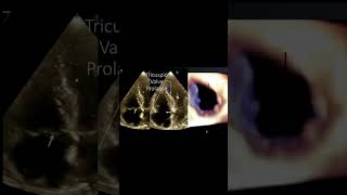 Tricuspid Valve Prolapse [upl. by Favrot]