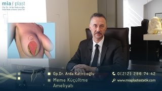 Meme Küçültme Ameliyatları  Op Dr Arda Katırcıoğlu [upl. by Venn]