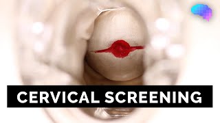 Cervical Screening SMEAR  OSCE Guide  UKMLA  CPSA [upl. by Yralam]