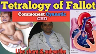 Tetralogy of Fallot  TOF  Commonest Cyanotic CHD  TET Spell  Cyanotic Spells [upl. by Sibylle]